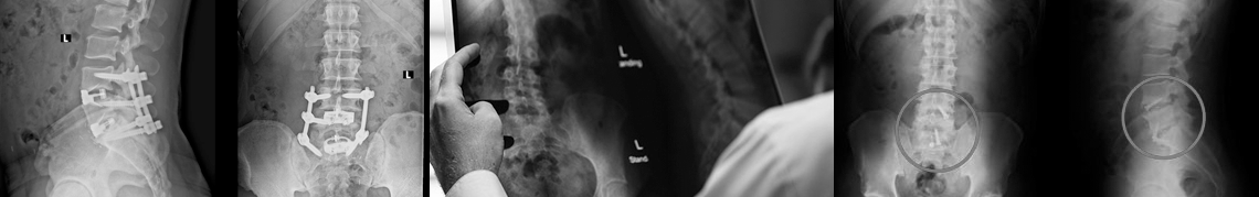 xrays of back injuries