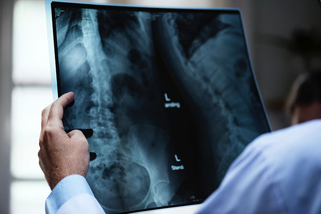 Doctor looking at spine xray of previous injury
