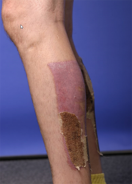 leg burn injuries