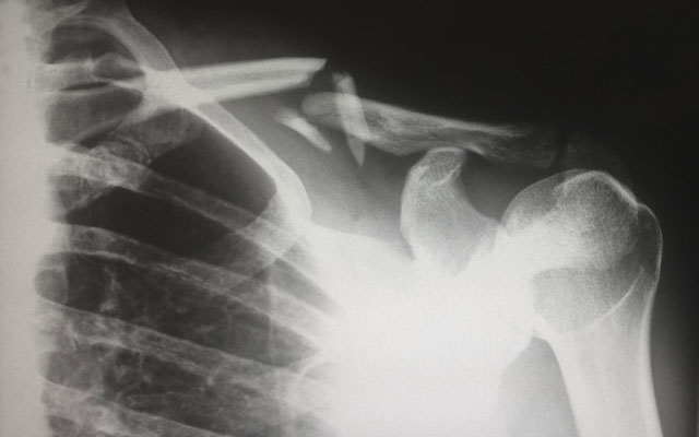 xray of shoulder injury