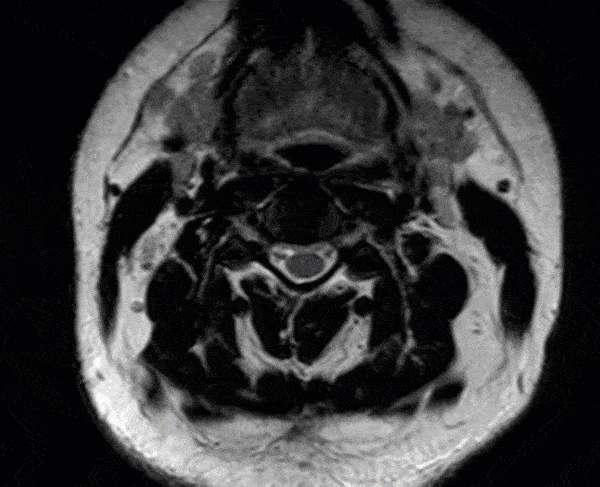 3T Brain MRI of Former Client