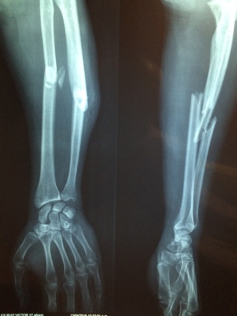 fractured arm bone