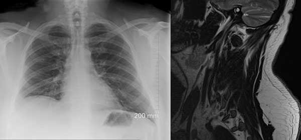 MRI of neck injury