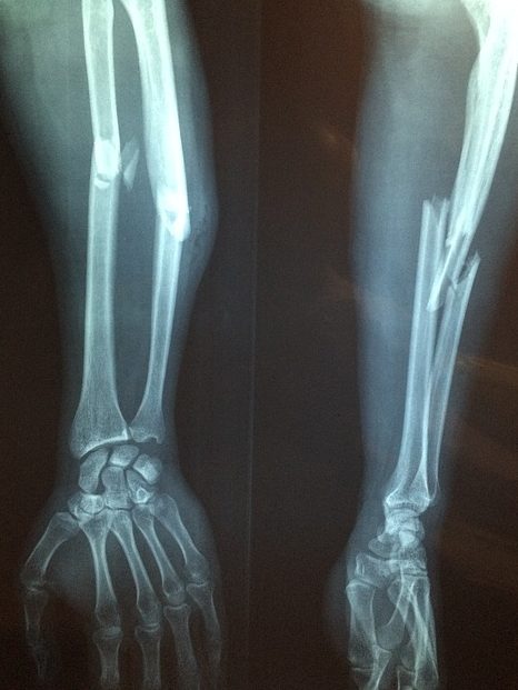 fractured arm bone